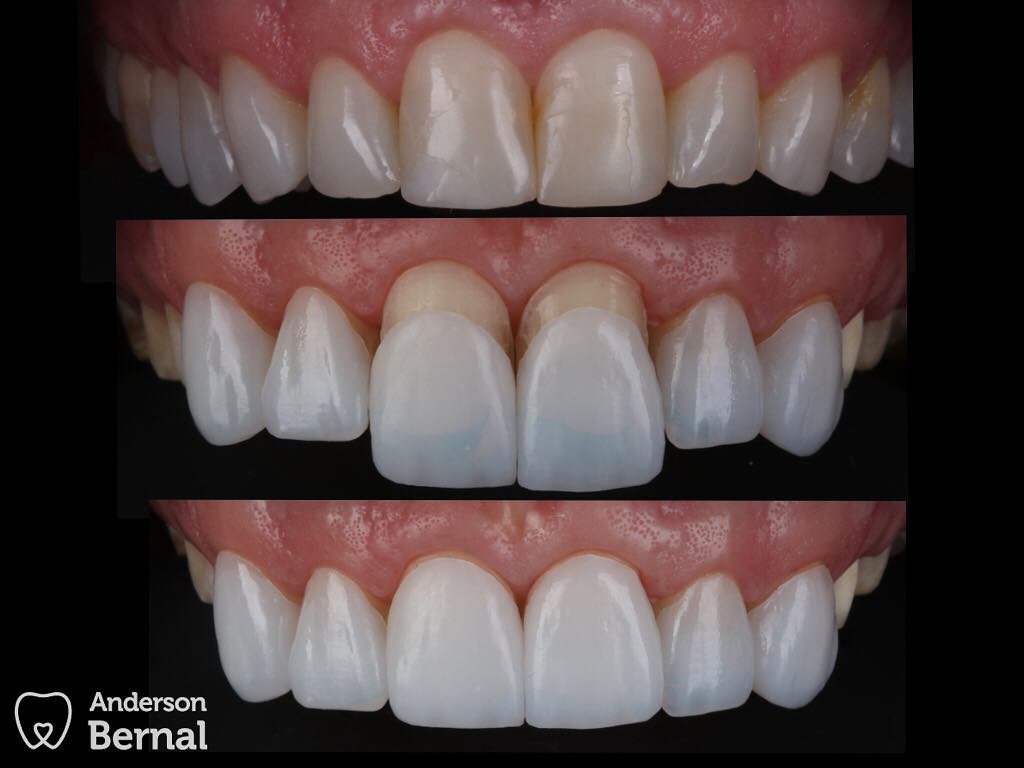 lente de contato dental